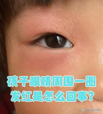 眼睛周围闪烁是怎么回事