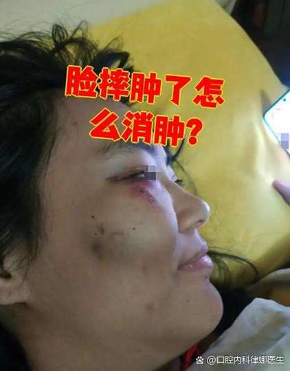 脸部摔肿了怎么消肿最快