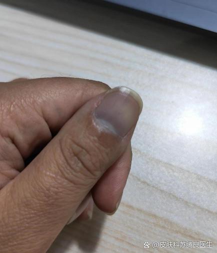 指甲盖有竖纹发紫