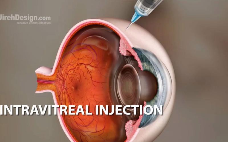 intracranial