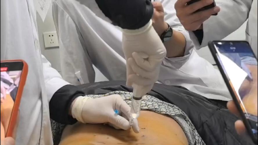 侧隐窝注射是封闭针吗