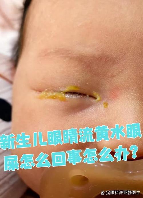 婴儿眼睛经常流眼水