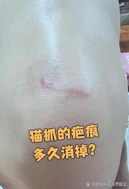 猫抓疤痕多久能消除