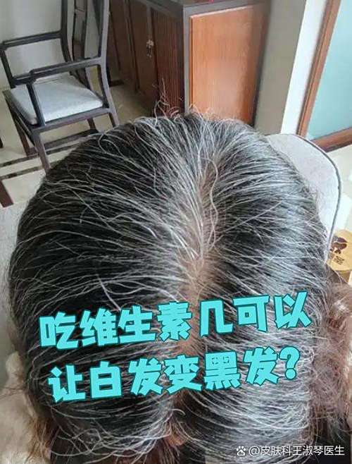 白头发吃什么能变黑