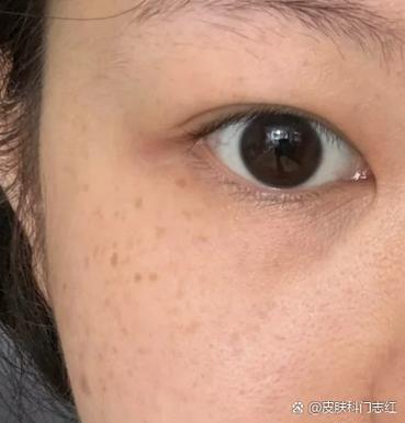 脸上有圈圈斑怎么回事