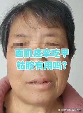 面部痉挛用什么药治疗最好
