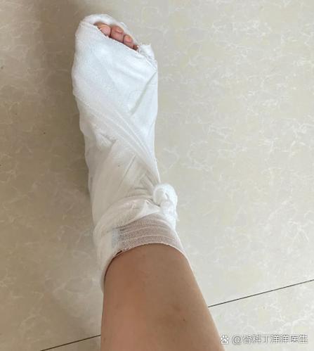 脚健断了多久能走路