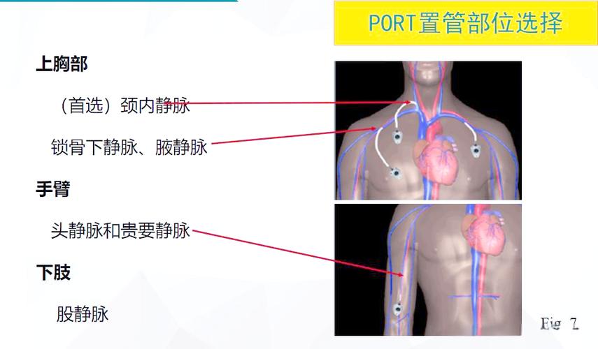 输液港多久取出比较好