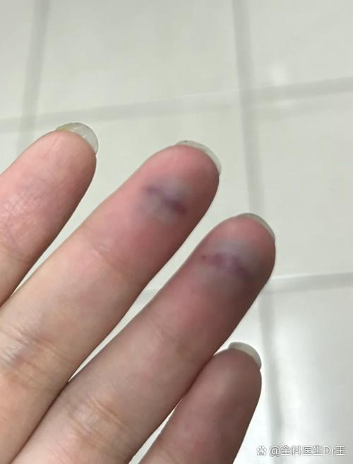 手指突然疼痛发紫像淤血