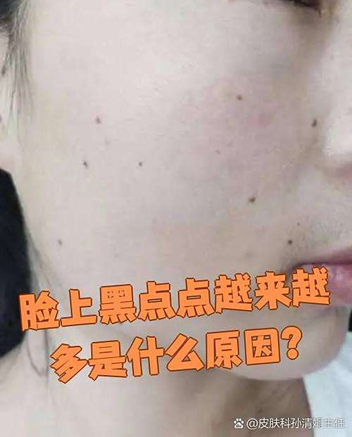 脸上长黑点怎么回事