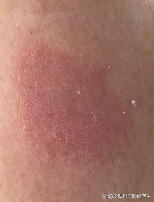 皮肤痒一挠就发红发紫