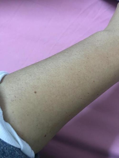 身上有紫色的小点是怎么回事缩略图