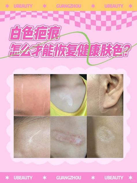 白色疤痕能恢复肉色么