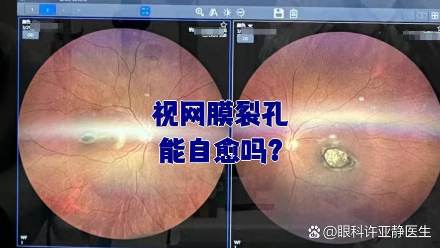 视网膜裂孔能自愈吗