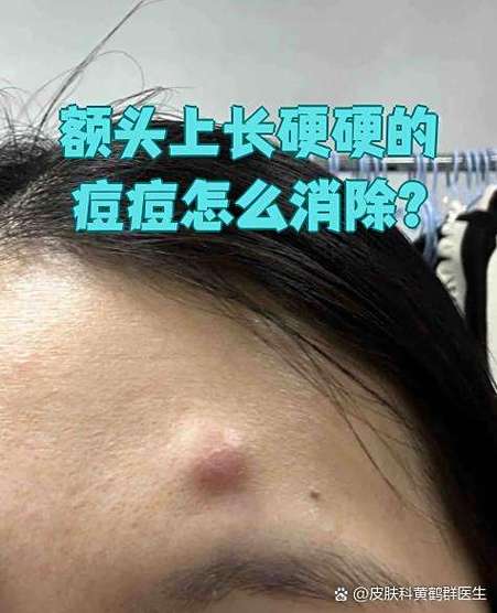 脸上的痘痘肿成硬块