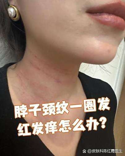 脖子颈纹处红痒像勒痕