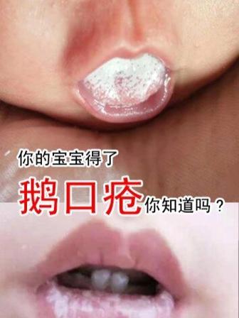 鹅口疮一般几天恢复缩略图