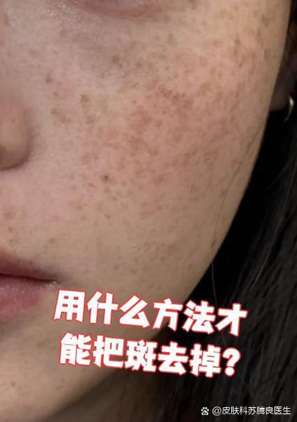 用什么办法可以去斑点