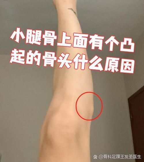 小腿迎面骨摸上去有凸起图片