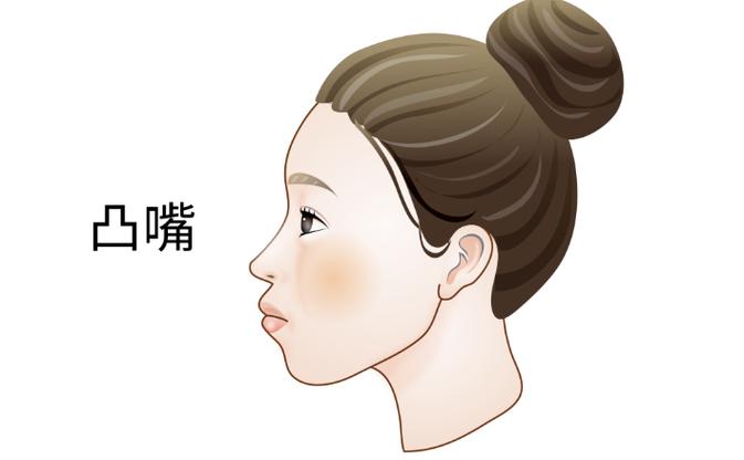 凸脸型侧面图