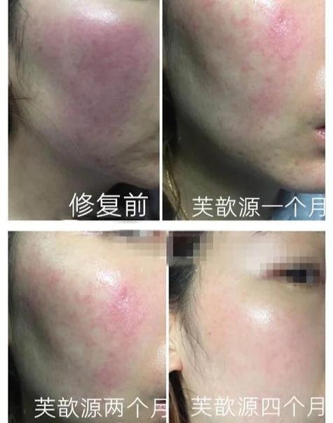 脸部擦伤了怎么才能快速恢复