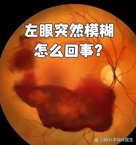 突然眼睛模糊缩略图
