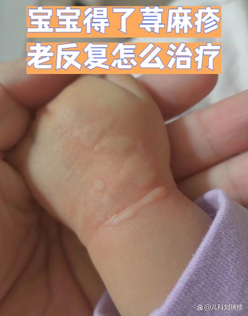 过敏最快解决办法