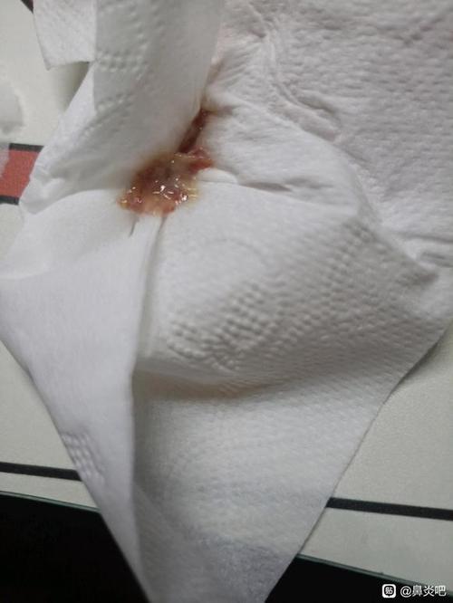 鼻涕带血几个月了一直好不了