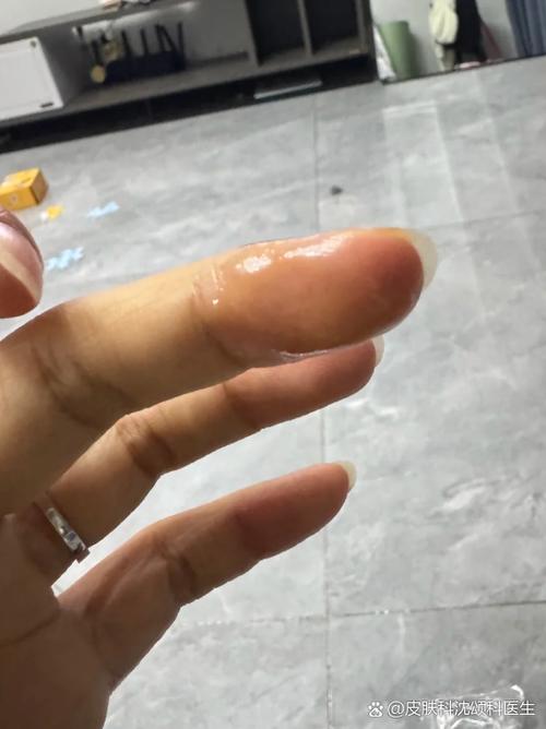 不小心碰到火碱怎么办