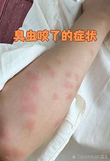 床上臭虫多晚上咬人怎么办