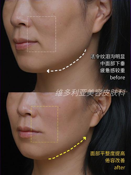 热玛吉抗衰老效果截图