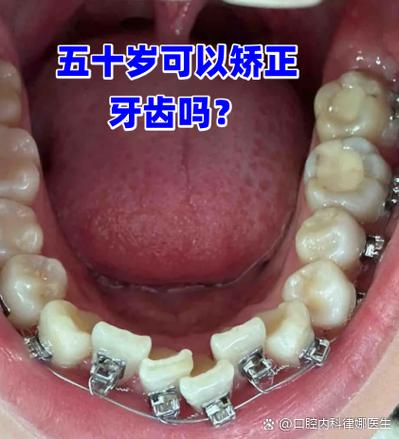 能单独矫正一颗牙吗