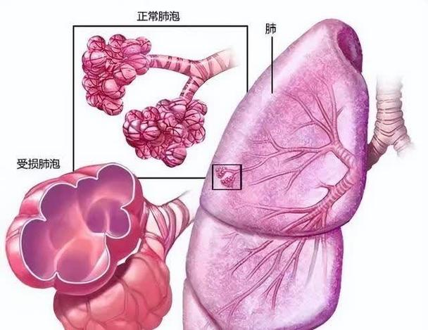 肺泡是怎么引起的