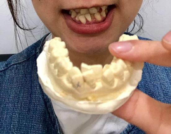 牙齿摔歪了能掰正吗