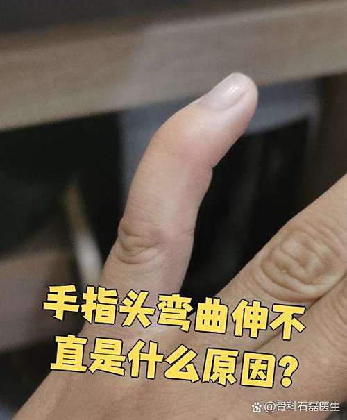 手指弯曲是什么原因