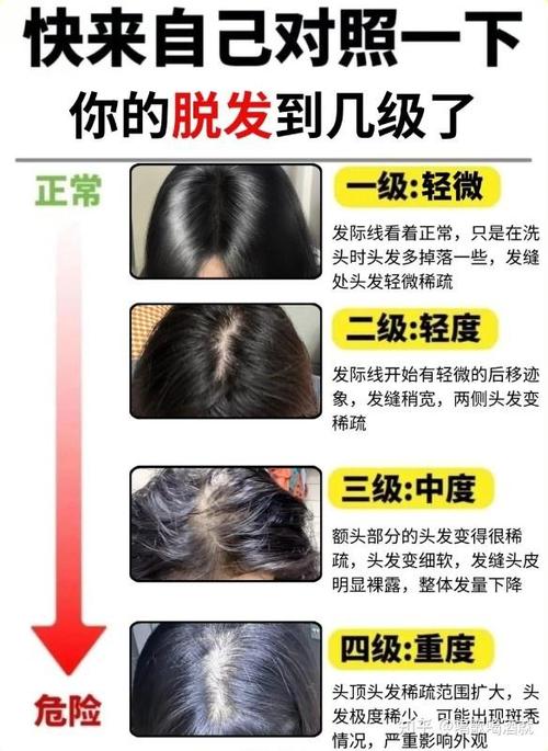 头顶脱发严重怎么办