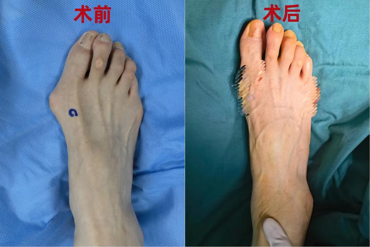 拇外翻手术过程视频