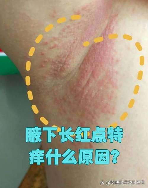 腋下起了很多红点特别痒