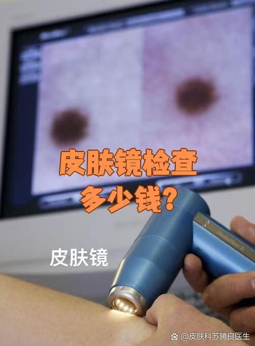 皮肤镜检查大概多少钱