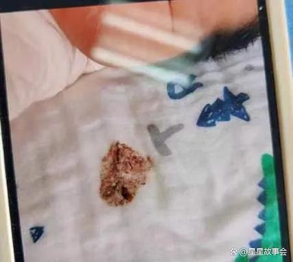 吐出凝固血块怎么回事