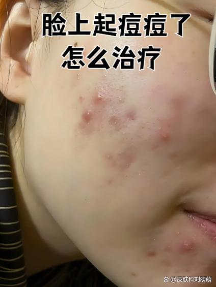 怎么消痘痘最快最有效