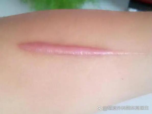 去疤痕疙瘩最有效方法图标