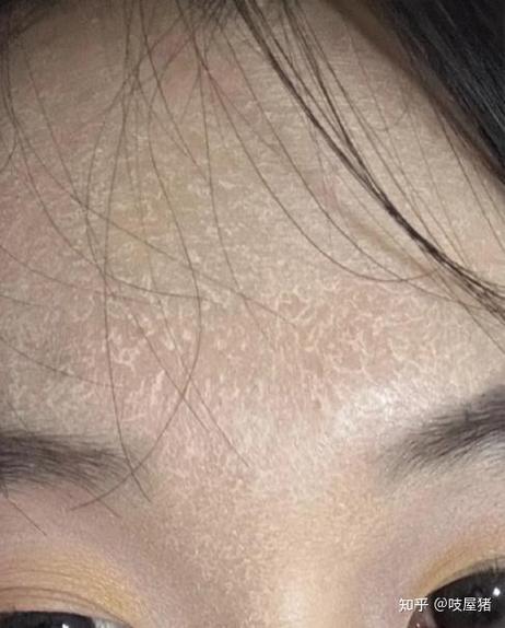 半青皮一般用几年掉皮