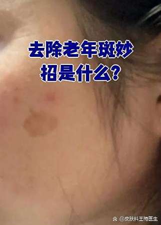 老年斑用什么方法除掉