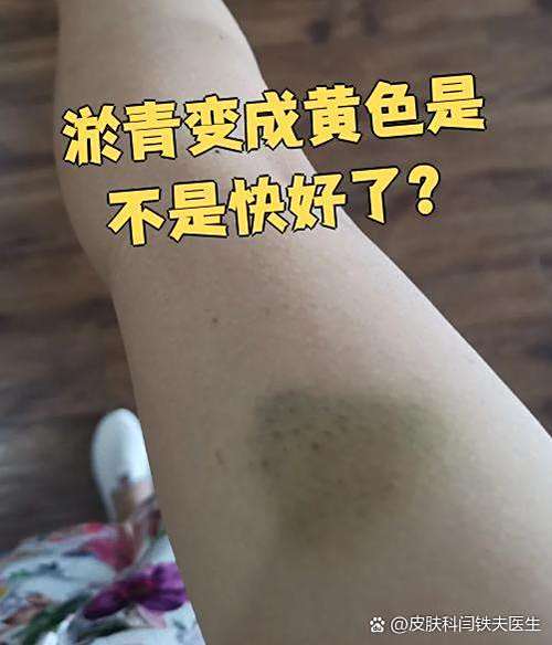 腿部突然出现淤紫