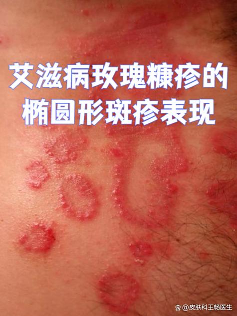 怀疑艾滋病挂什么科