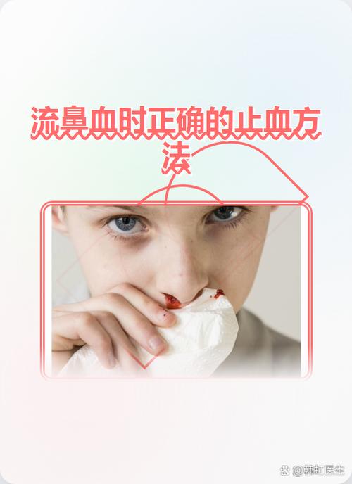 鼻血流不停怎么止血