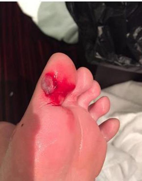 手指受伤图片真实