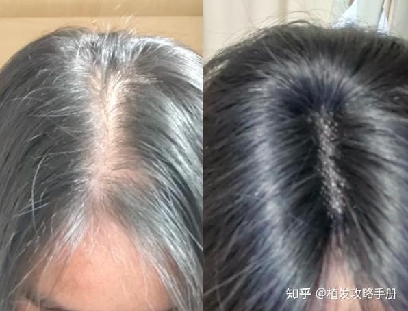 戴假发好还是植发好