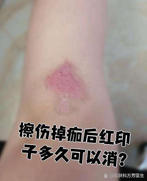 脸上一直有红色的印子